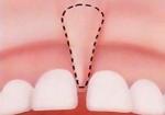 Lista de preturi silicon, clinica dentara