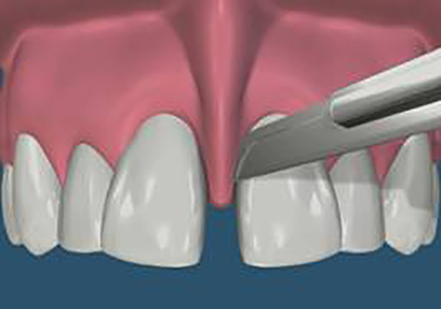 Лечение зубов недорого в бутово