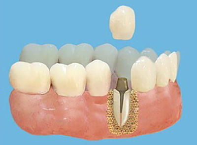 Лечение зубов в балашихе